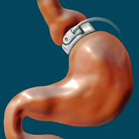 Vertical Sleeve Gastrectomy Treatment in Guntur, Best Bariatric Surgery Treatment in Guntur, Mini Gastric Bypass Treatment, Roux-En-Y Gastric Bypass Treatment in Guntur, Best Obesity Surgeon in Guntur, Weight Loss Surgery Treatment in Guntur