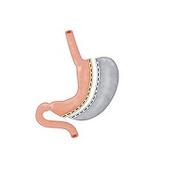 Vertical Sleeve Gastrectomy Treatment in Guntur, Best Bariatric Surgery Treatment in Guntur, Mini Gastric Bypass Treatment, Roux-En-Y Gastric Bypass Treatment in Guntur, Best Obesity Surgeon in Guntur, Weight Loss Surgery Treatment in Guntur